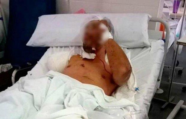 Ladrón fue atacado por un pitbull y debieron amputarle un brazo