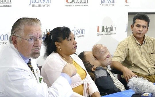 Murió el niño cubano al que le extirparon un tumor facial de más de 4 kilos