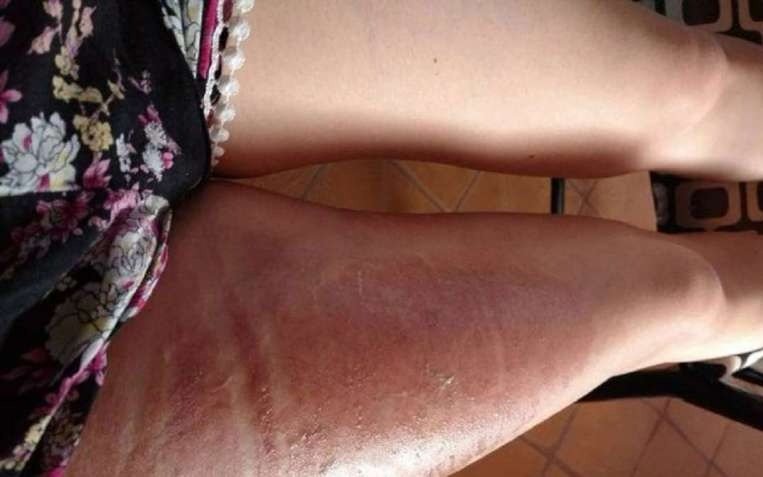 Una joven sufrió quemaduras por el líquido de la funda de su celular, que se pinchó
