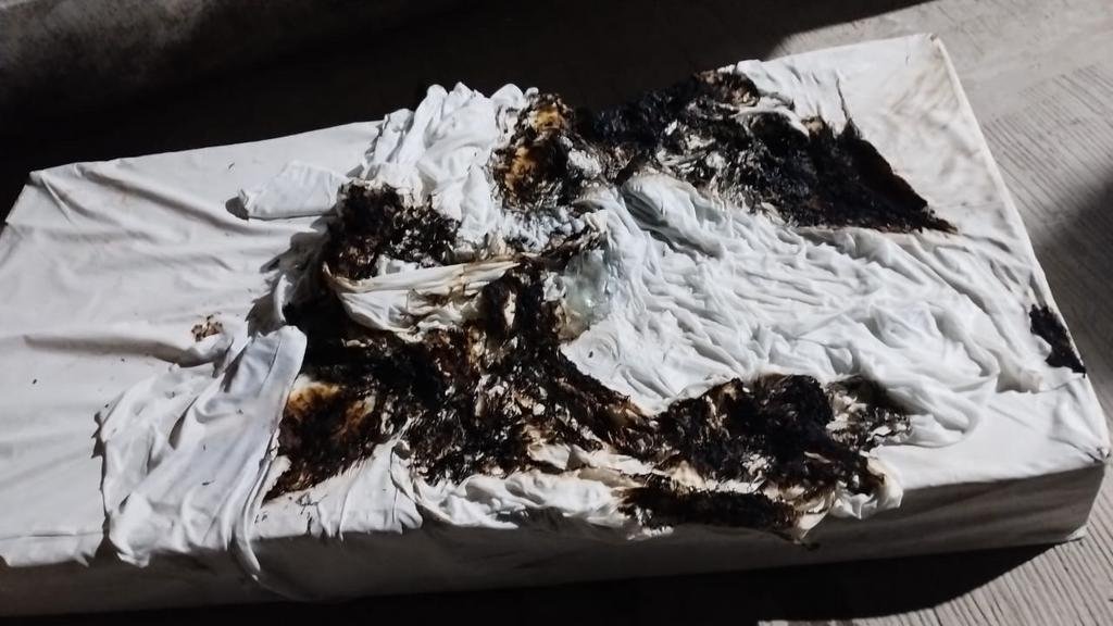 Murió el paciente que había sido prendido fuego mientras dormía
