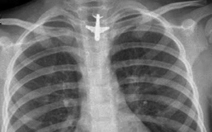 Objetos extraños: desafío para guardias pediátricas