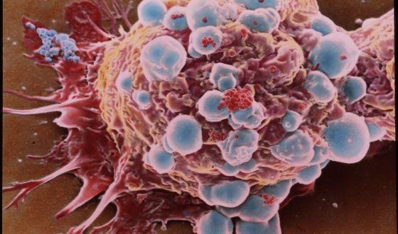 Identificaron un gen esencial en la resistencia de un cáncer de mama agresivo