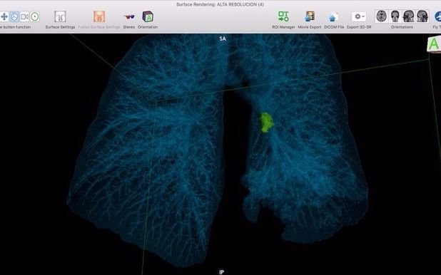 Extirparon un tumor pulmonar gracias a tecnología 3D