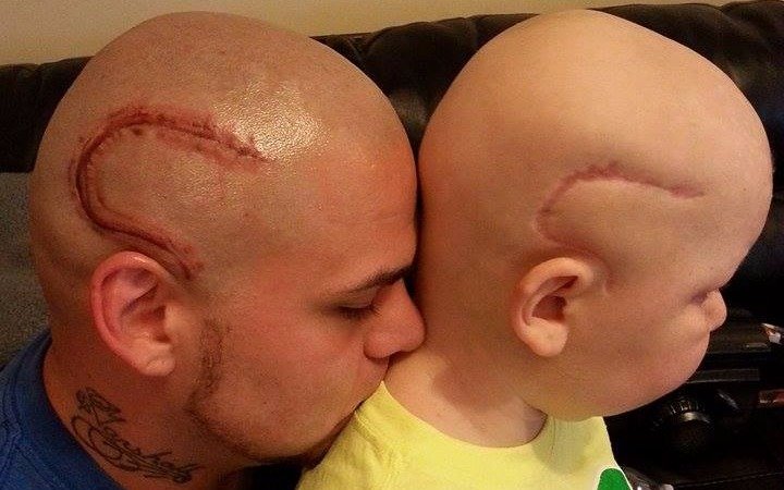 Tras una difícil lucha contra el cáncer murió el niño cuyo padre se tatuó una cicatriz igual a la suya en la cabeza