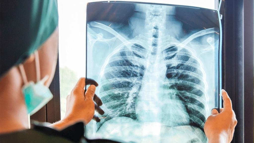 Cáncer de pulmón: aunque se fuma menos, es alto en el país