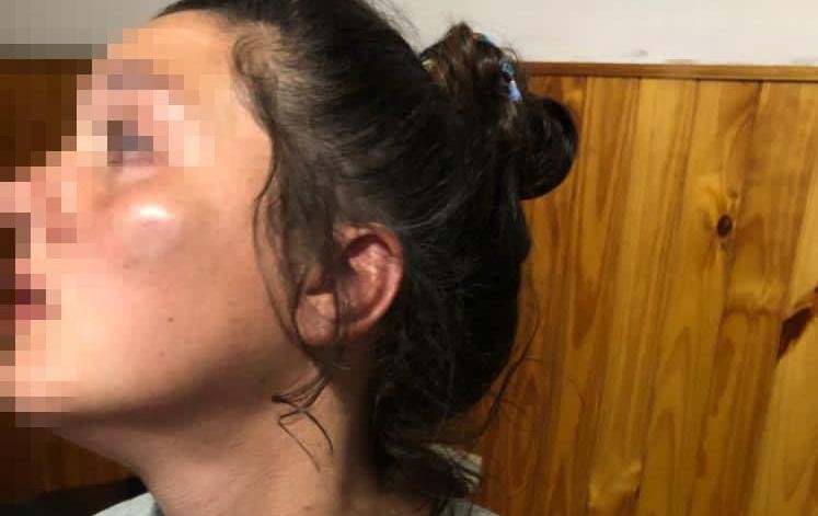 Atacó a trompadas a su pareja y le dejó el rostro a la miseria