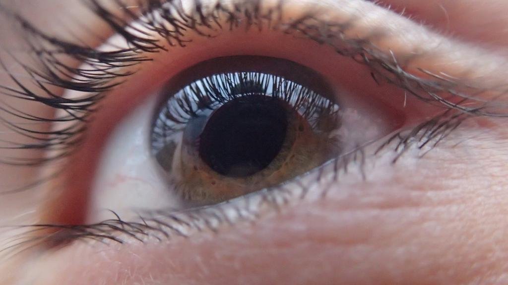 Glaucoma: la enfermedad silenciosa que puede causar ceguera
