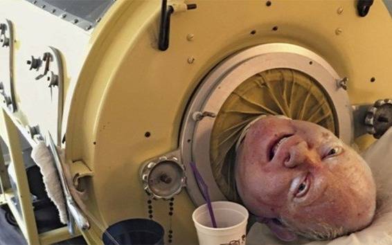 Murió Paul Alexander, el hombre del pulmón de acero, a los 78 años