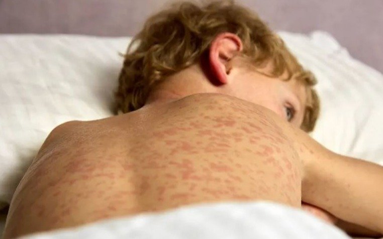 Sarampión en el AMBA: detectan otros cuatro casos y ya son ocho los infectados