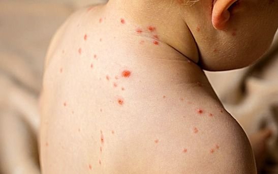 La Provincia en alerta por el brote de sarampión y ya dan dosis de refuerzo: síntomas y cómo se contagia