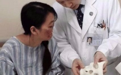 Utilizan impresora 3D para reconstruir nariz y boca de una mujer