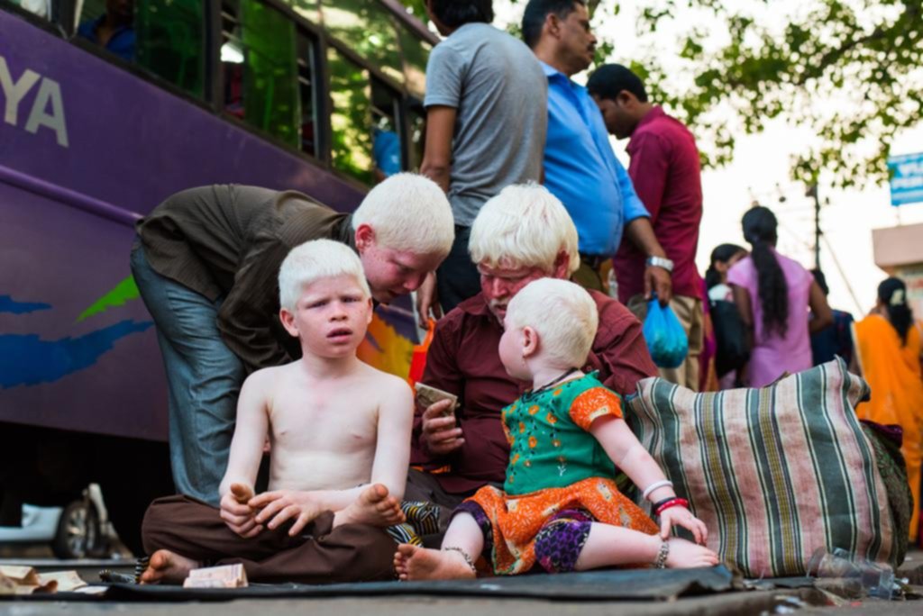 Elogio de la ONU sobre un proyecto argentino para ayudar a personas albinas