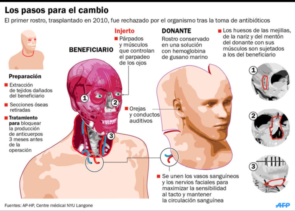 El hombre de las tres caras, un logro de la ciencia en trasplantes de rostro