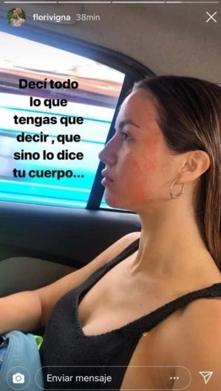 Corazón roto: Flor Vigna se separó y se le brotó toda la cara