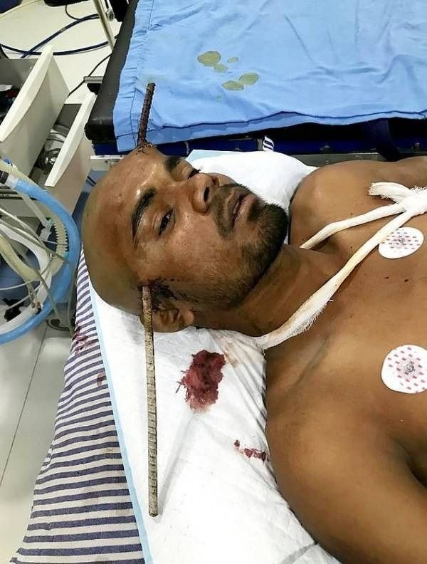 Con un Dios aparte: un hierro le atravesó de lado a lado la cabeza y la cuenta de milagro