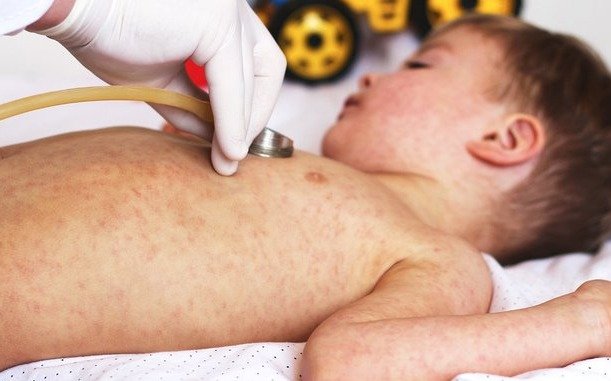 Alertan sobre un avance sigiloso del sarampión en Sudamérica