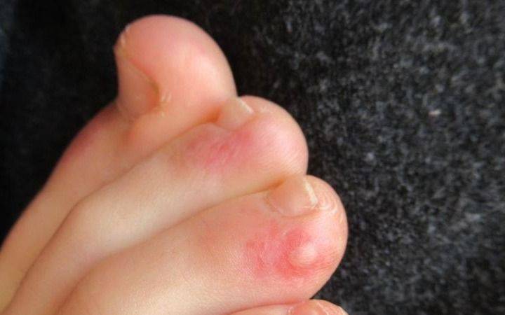 Coronavirus: ¿Cómo se manifiesta en la piel?