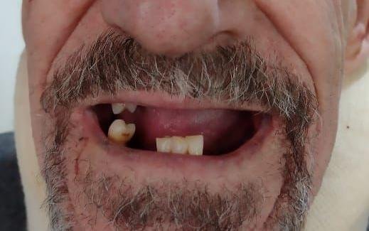 Le sacan varios dientes a un sereno en un salvaje atraco