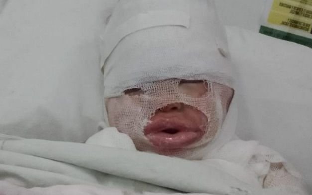 Volcaron aceite hirviendo a una nena de 3 años y está internada en el Hospital de Niños de La Plata