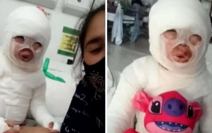 "Quiero a mi hija viva": habló la mamá de la nena que tiene el 54% de su cuerpo quemado con aceite