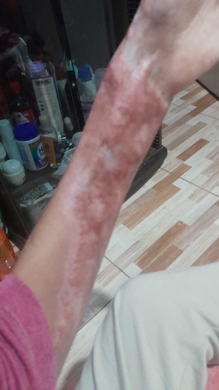 El dramático reclamo de una joven que se quemó a lo bonzo