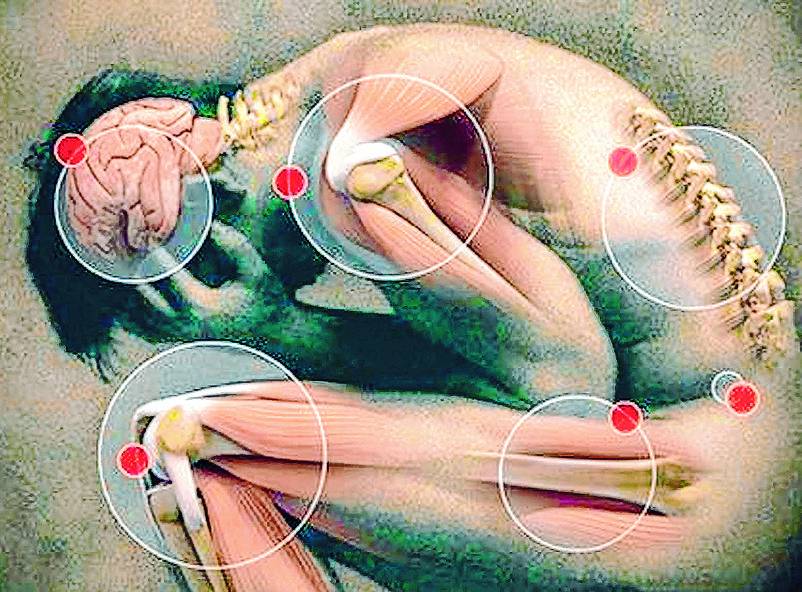 A las personas con fibromialgia les toma hasta diez años dar con la causa del dolor 