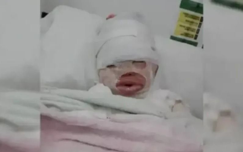 Sigue internada la nena quemada en Florencio Varela