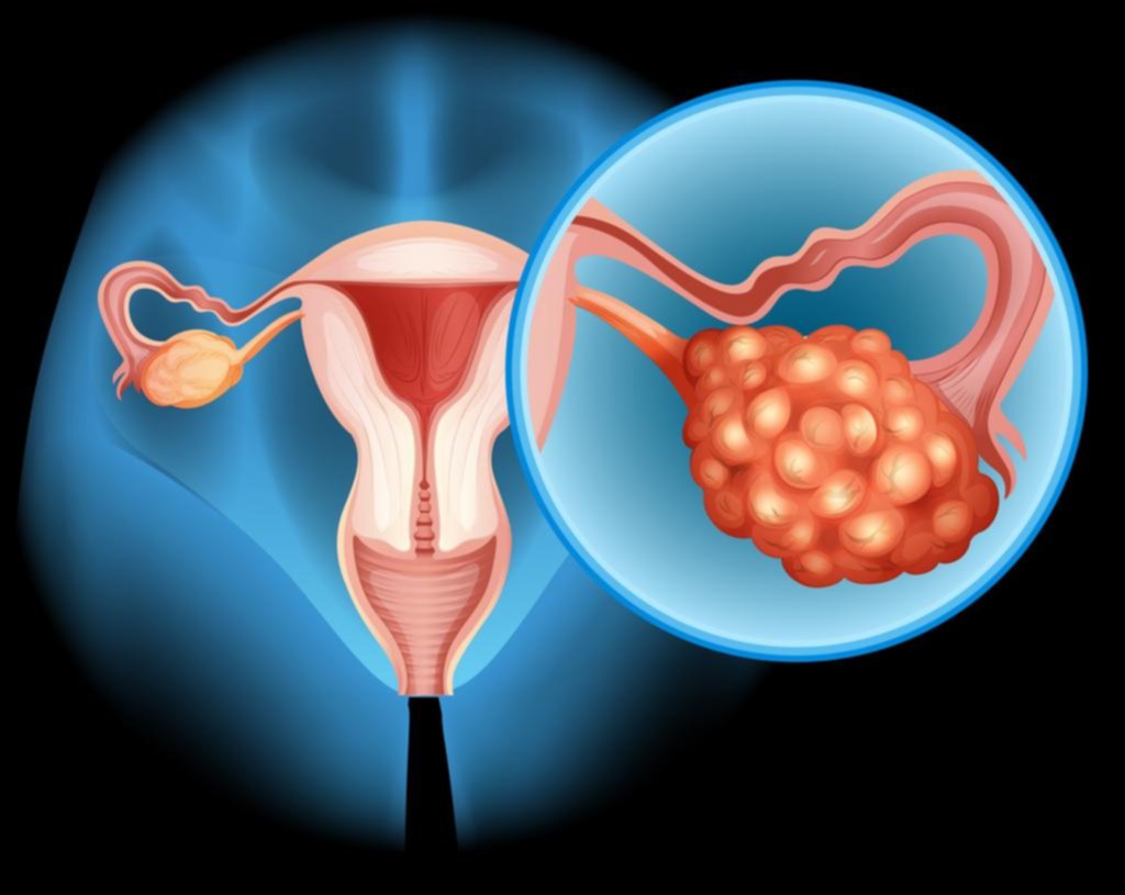 Más del 70% de los casos de cáncer de ovario se detectan en etapa avanzada