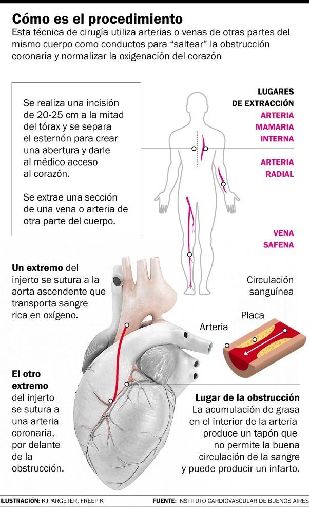Bypass coronario: a 55 años de su creación continúa salvando vidas