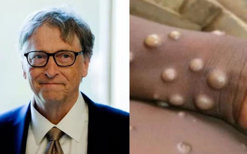 Viruela del mono: el pronóstico de Bill Gates que está próximo a cumplirse