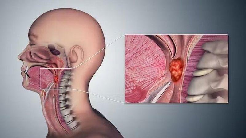 Salud: la influencia del sexo en el cáncer de garganta