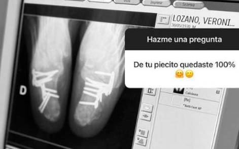 Vero Lozano y sus pies: “Hay días que duele mucho”