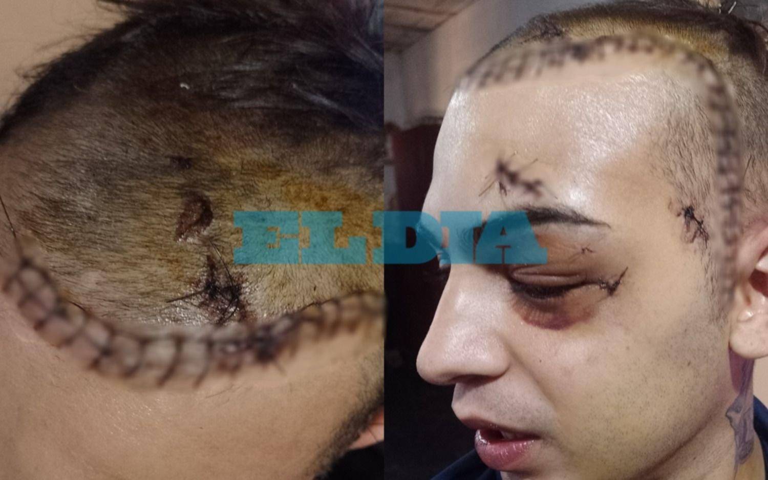 Brutal ataque y robo en Plaza Moreno: volver a nacer y secuelas que lo llevarán de nuevo al quirófano