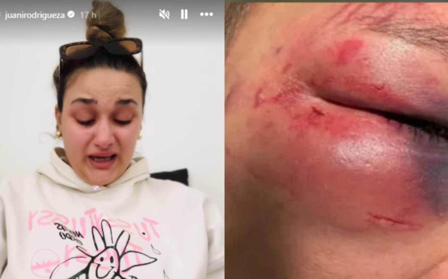 Paliza brutal en un boliche de La Plata: otro desgarrador posteo de la novia del joven desfigurado