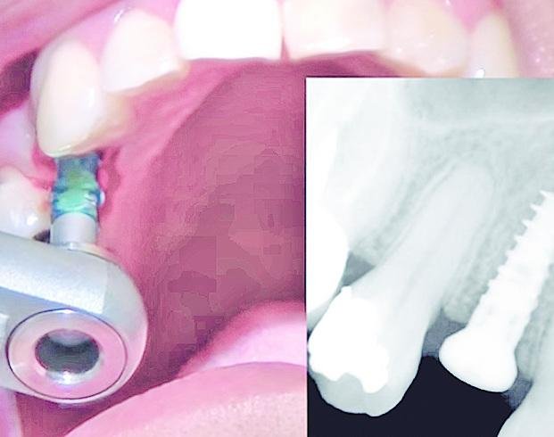 Buscan evitar el rechazo a los implantes dentales