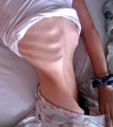 Mostró los estragos que le hizo la anorexia y su mejoría se volvió viral