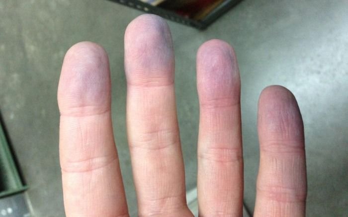 Qué es la esclerodermia, la enfermedad de los dedos azules que padecen miles de argentinos