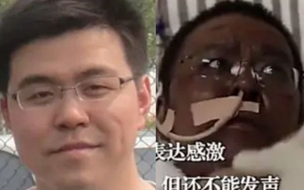Murió el médico chino al que le cambió el color de piel tras contagiarse de coronavirus