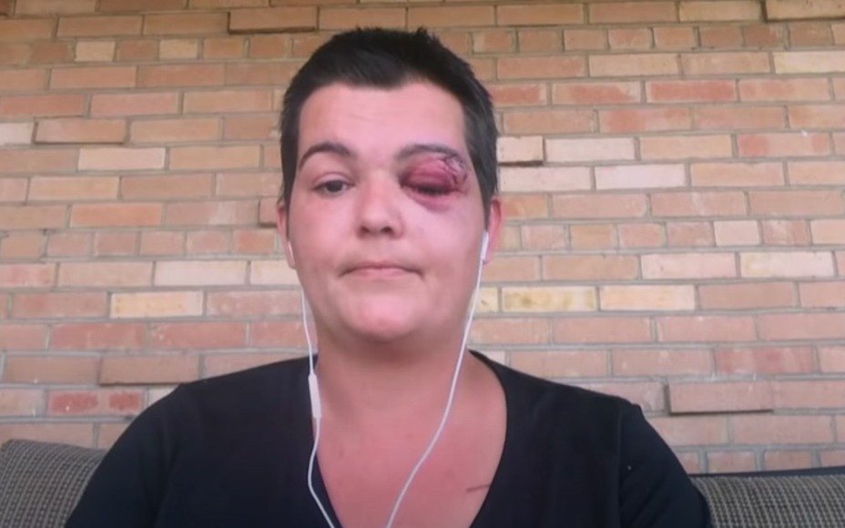 Mundo cyborg: perdió un ojo en una protesta por Floyd y le ofrecieron un reemplazo biónico