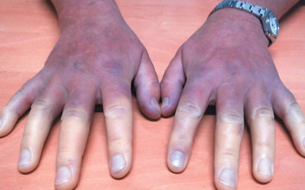 Esclerodermia, la enfermedad autoinmune que va más allá del endurecimiento de la piel