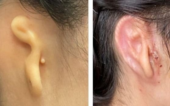 Inédita reconstrucción de una oreja producida en una impresora 3D con células propias