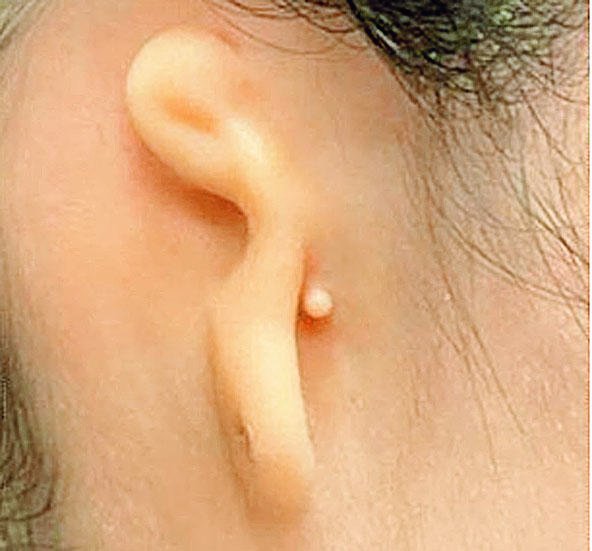 Trasplantan por primera vez una oreja impresa con células humanas