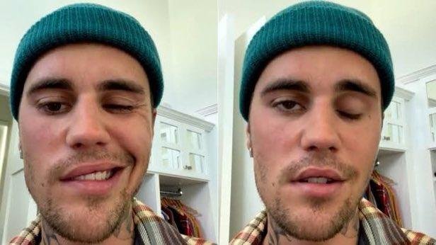 Justin Bieber: con media cara paralizada por un síndrome, el cantante debió suspender sus shows