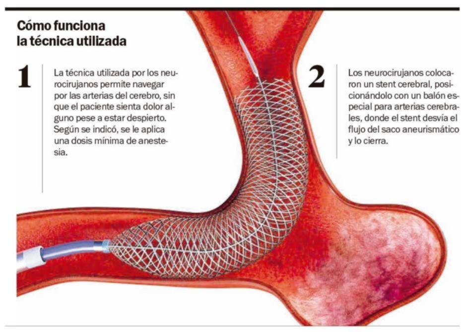 Avance platense: así fue la innovadora cirugía en el Hospital Italiano
