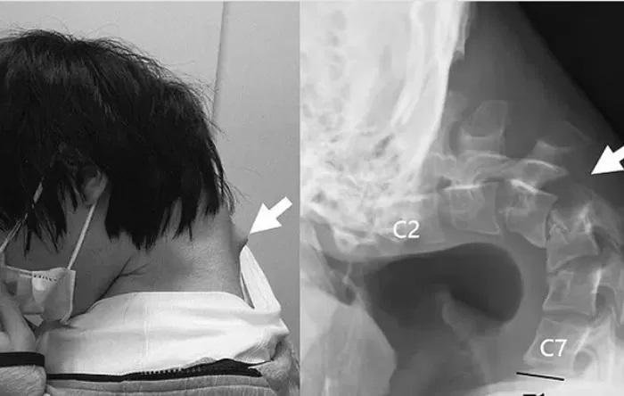 Por mirar demasiado el celular, desarrolló el “síndrome de cabeza caída”