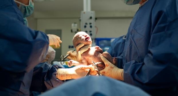 Advierten sobre efectos negativos de la epidural en los bebés