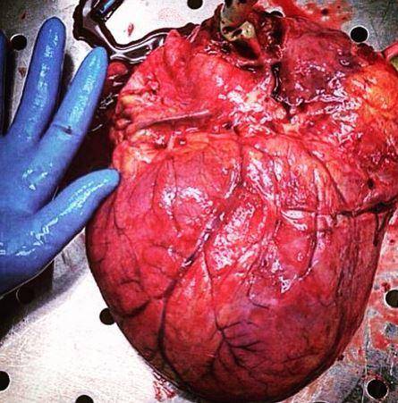 En un trasplante, el corazón de un adicto a las drogas latió durante 25 minutos fuera de su cuerpo