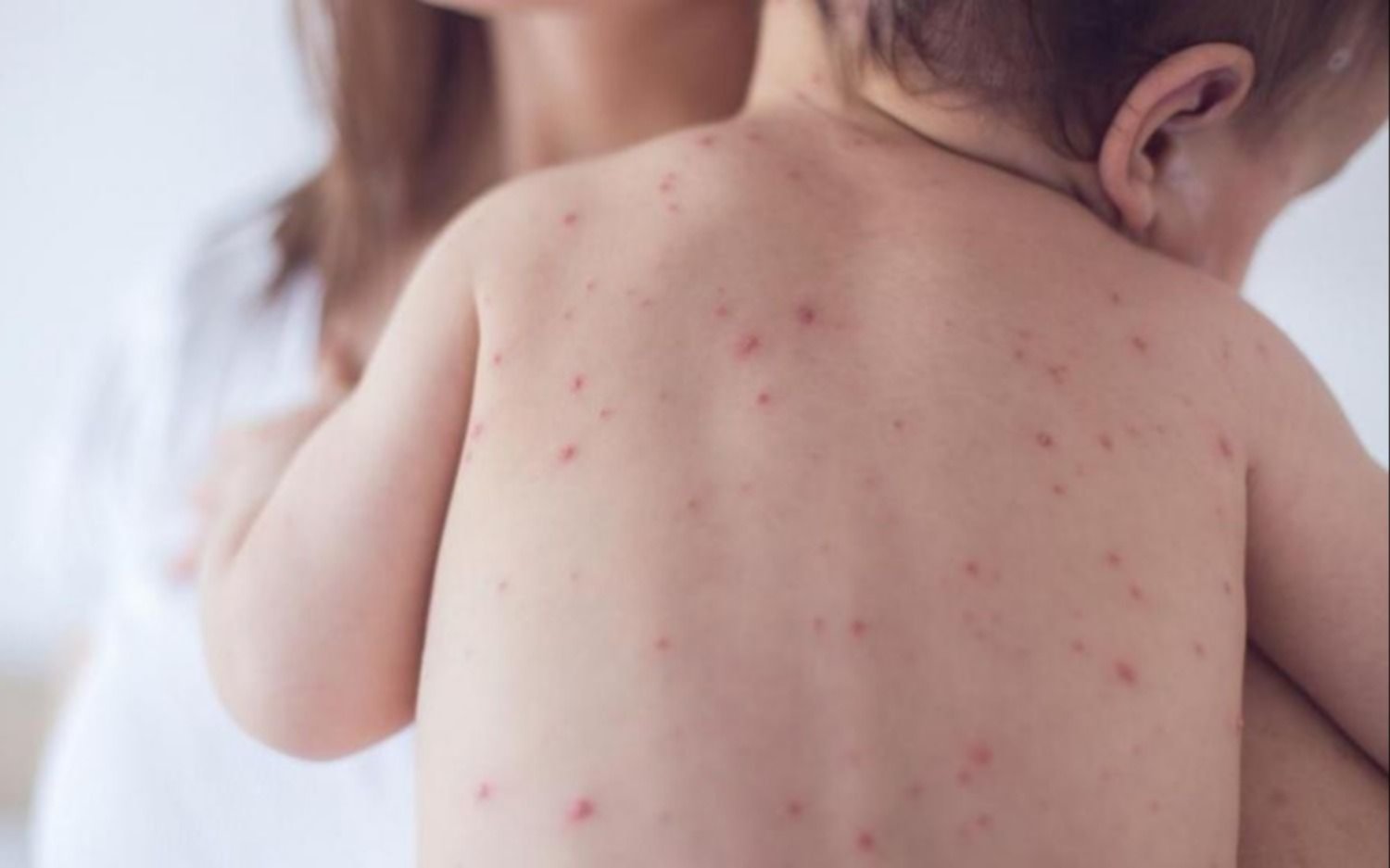 Detectan más casos de sarampión 