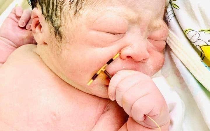 Increíble: nació un bebé con el DIU de su madre en la mano