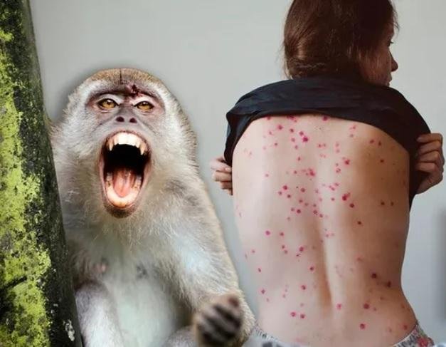 Viruela del mono: por qué la OMS activó su máximo nivel de alerta